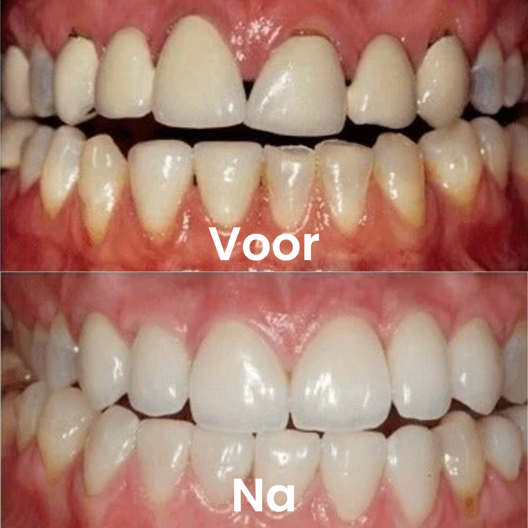 GumRepair™ | Herstel terugtrekkend tandvlees en bescherm je glimlach – helemaal natuurlijk